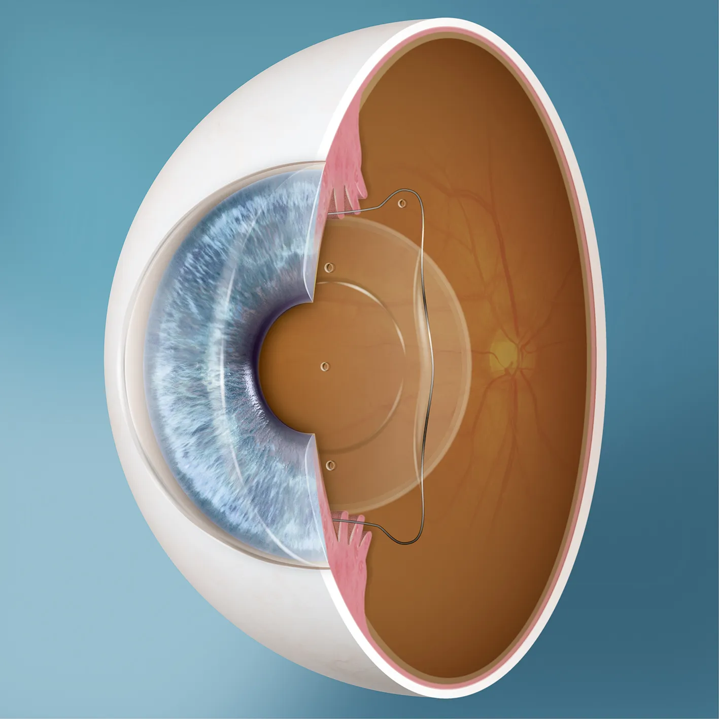 EVO ICL_Sitz im Auge