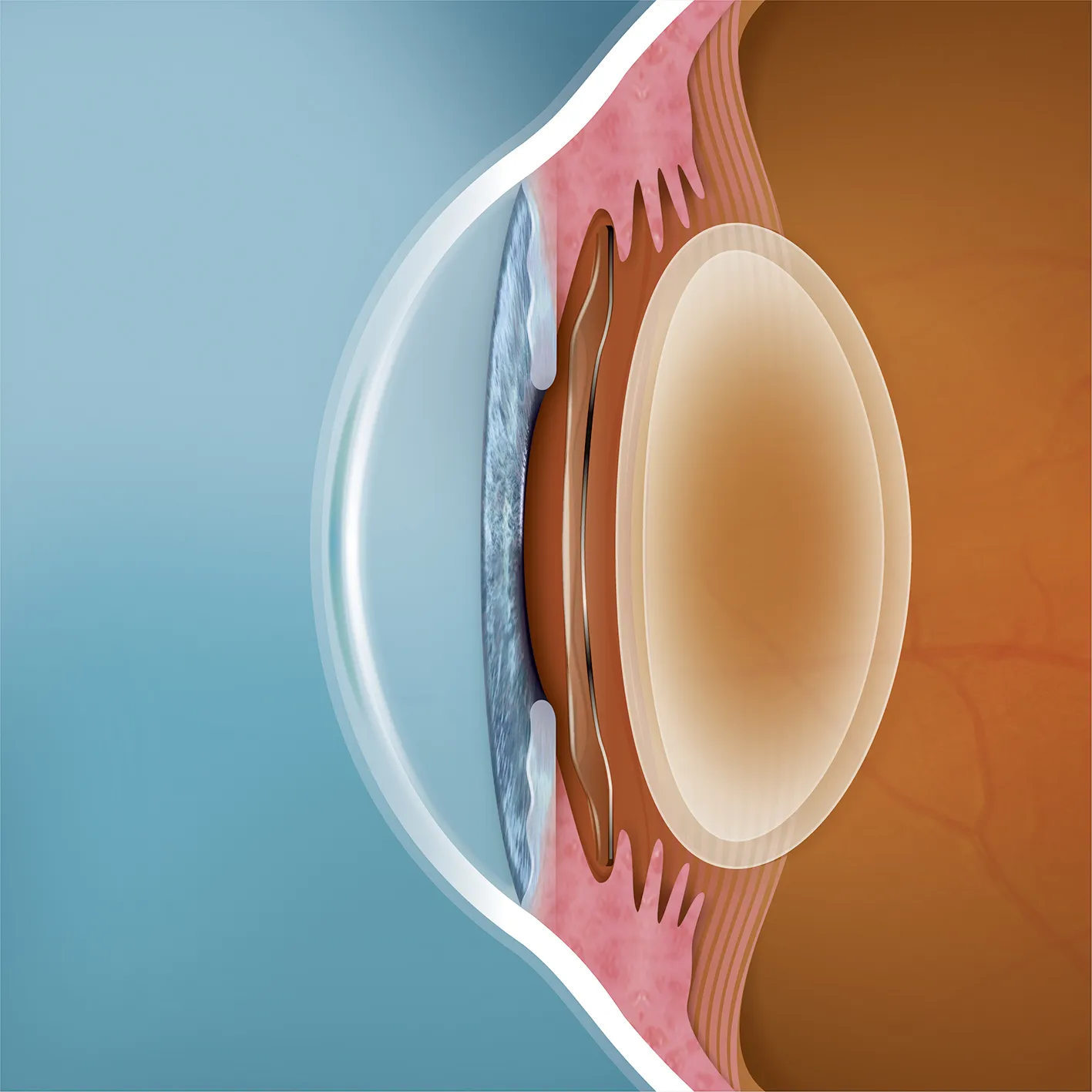 Linse im Auge nach OP