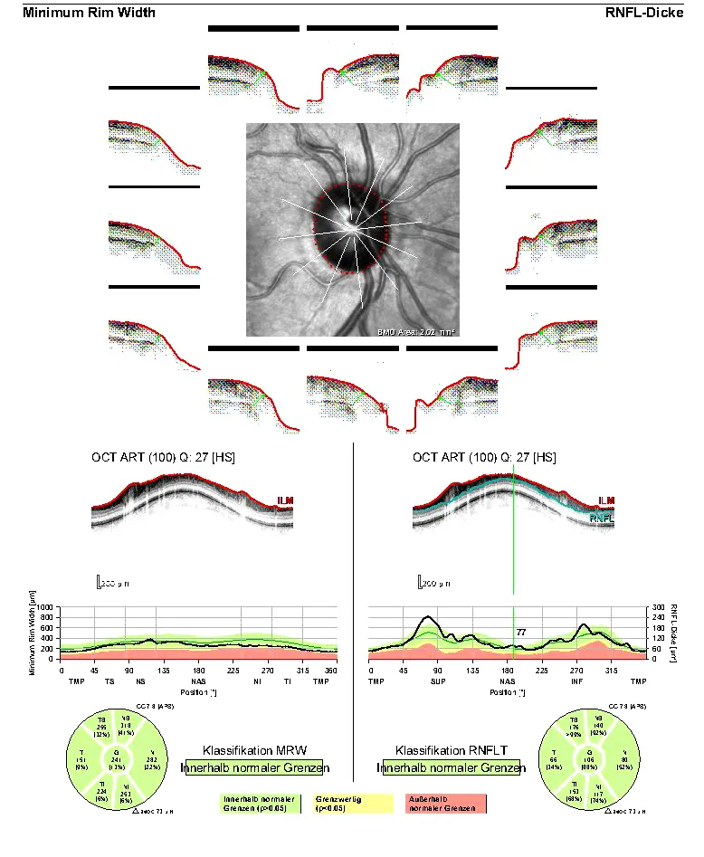 Optische Kohärenztpomografie - Darstellung des Sehnerven Nervenfaserschicht