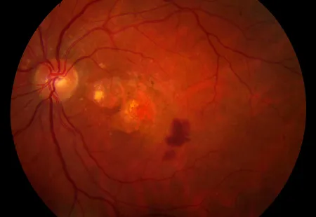 AMD - Feuchte Makuladegeneration