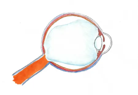 Glaskörperabhebung