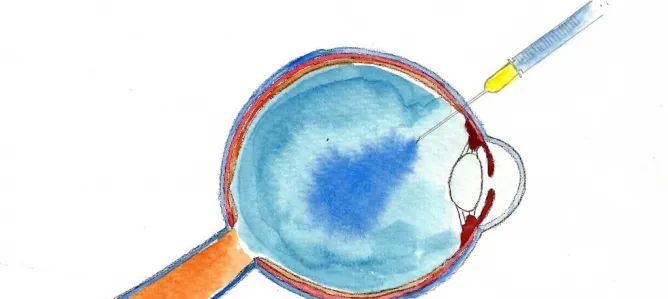 Intravitreale operative Medikamenteneingabe (IVOM)