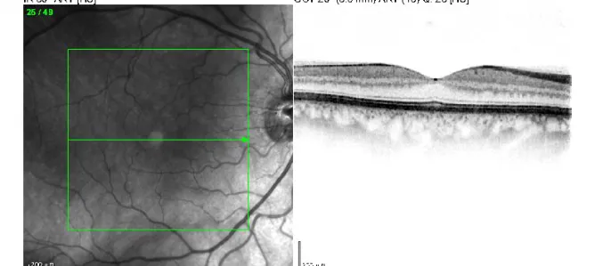 Optische Kohärenztomografie - Makula